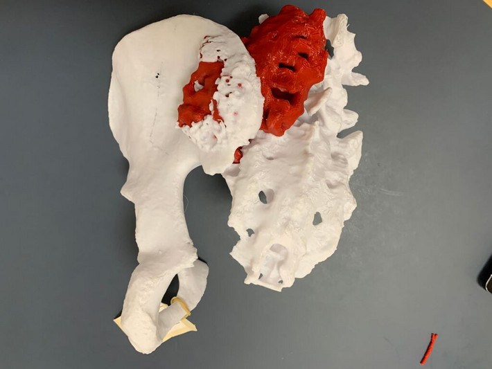 3D-print af sarkomet hos en ung mand, som Thomas Baad-Hansen for nyligt har opereret. På 3D-modellen er sarkomet rødt, og man kan se, hvordan det sidder fast i bækkenet, korsbenet og rygsøjlen.